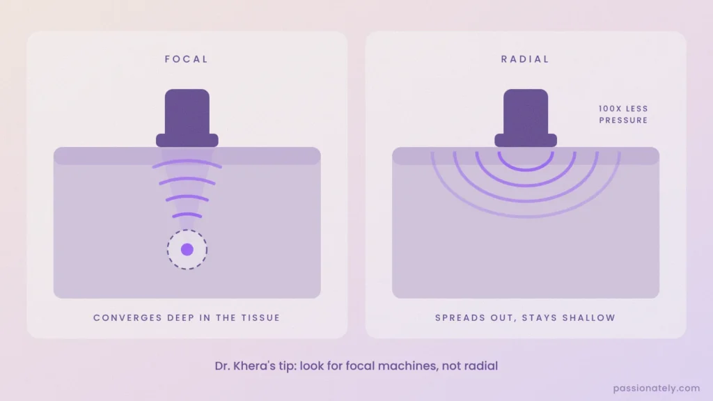 Diagram comparing focal shockwaves focusing deep in the tissue with radial shockwaves spreading out shallow
