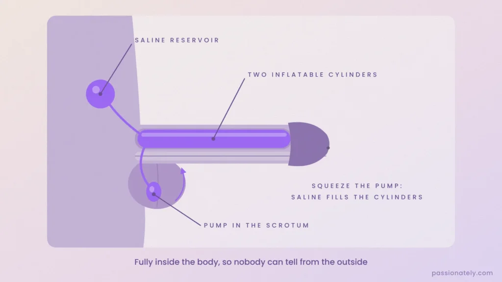 Diagram of a three-piece inflatable penile implant with two cylinders, a saline reservoir and a pump in the scrotum
