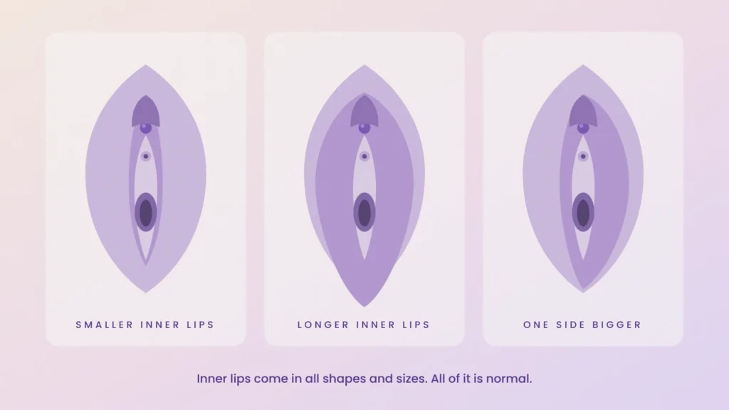 Diagram of three vulvas showing smaller inner lips, longer inner lips and one side bigger